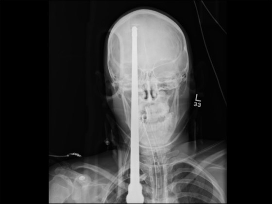 معجزة حقيقية: نجاة مراهق من الموت بعد أن اخترق رمح جمجمته صورة رقم 1