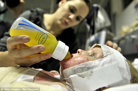 صور اولية لطفلة تعافت من اخطر الحروق بواسطة زرع جلد!  صورة رقم 5