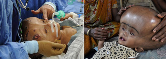 بالصور: الطفلة ذات الرأس المنتفخ تتعافى لكن مستقبلها في خطر صورة رقم 2 بالصور: الطفلة ذات الرأس المنتفخ تتعافى لكن مستقبلها في خطر صورة رقم 2