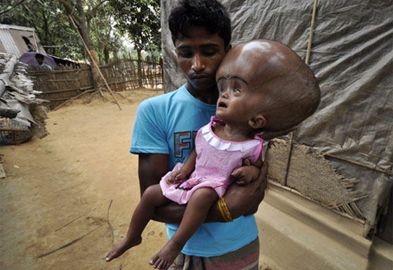 بالصور: الطفلة ذات الرأس المنتفخ تتعافى لكن مستقبلها في خطر صورة رقم 6 بالصور: الطفلة ذات الرأس المنتفخ تتعافى لكن مستقبلها في خطر صورة رقم 6