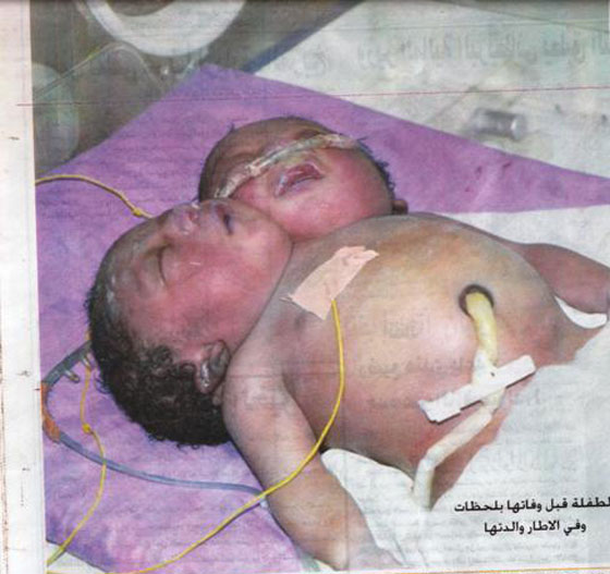 طفلة برأسين في السودان! صورة رقم 1 طفلة برأسين في السودان! صورة رقم 1