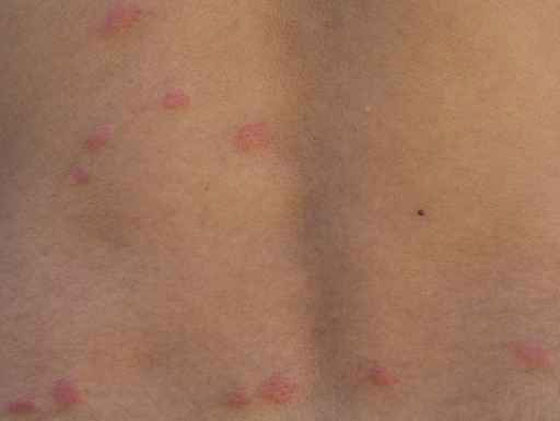 800 الف دولار تعويضا لامريكية عن لدغ البق صورة رقم 1