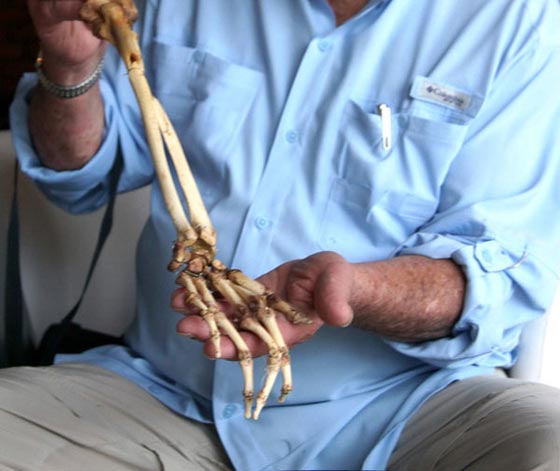 طبيب امريكي يعيد لجندي فيتنامي يده المبتورة منذ 35 عاما صورة رقم 7 طبيب امريكي يعيد لجندي فيتنامي يده المبتورة منذ 35 عاما صورة رقم 7