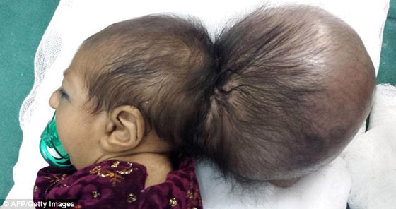 نجاح عملية خطيرة لطفلة افغانية ولدت مشوهه برأسين صورة رقم 1