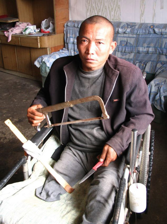 الصين: عجز عن توفير تكاليف العملية فقطع ساقه بسكين ومنشار صورة رقم 2