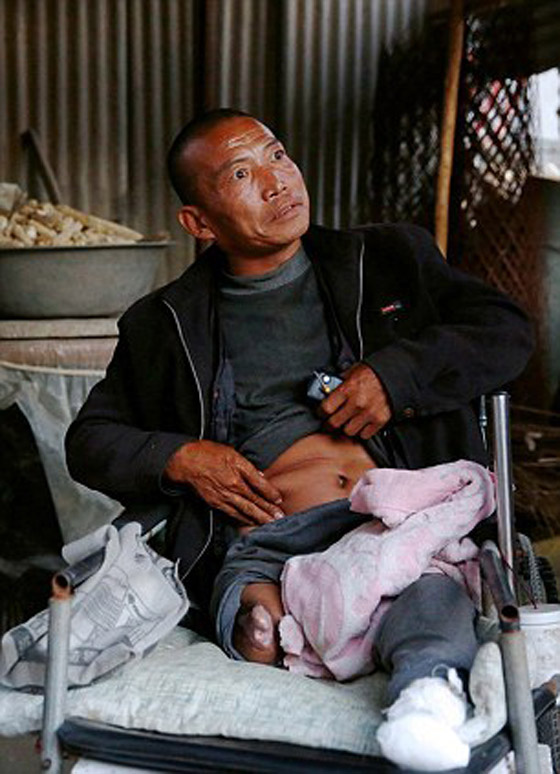 الصين: عجز عن توفير تكاليف العملية فقطع ساقه بسكين ومنشار صورة رقم 5