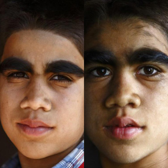 بالصور.. عائلة هندية تتخلص من متلازمة الذئبة بعلاج الليزر صورة رقم 3