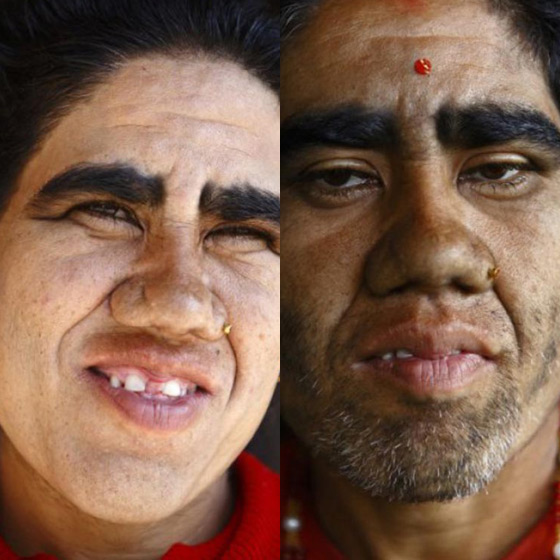 بالصور.. عائلة هندية تتخلص من متلازمة الذئبة بعلاج الليزر صورة رقم 1