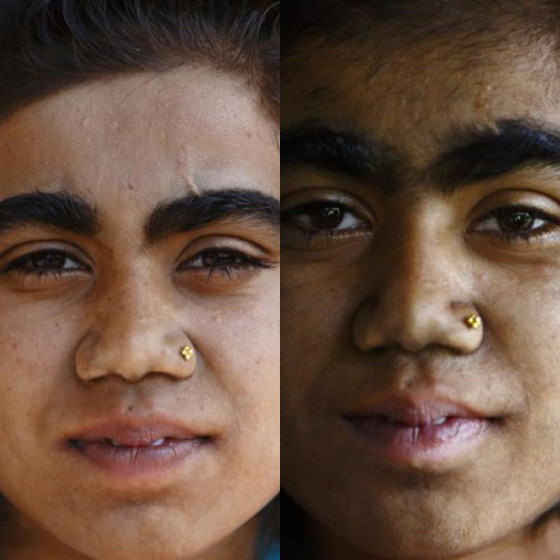 بالصور.. عائلة هندية تتخلص من متلازمة الذئبة بعلاج الليزر صورة رقم 2