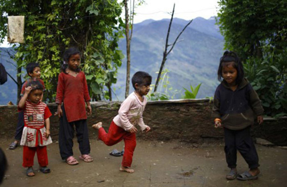 بالصور.. عائلة هندية تتخلص من متلازمة الذئبة بعلاج الليزر صورة رقم 5