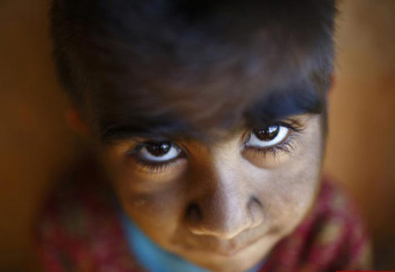 بالصور.. عائلة هندية تتخلص من متلازمة الذئبة بعلاج الليزر صورة رقم 7