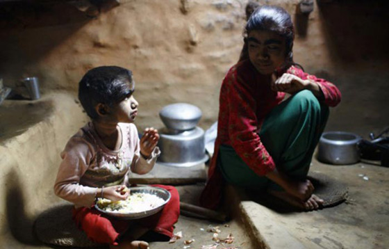 بالصور.. عائلة هندية تتخلص من متلازمة الذئبة بعلاج الليزر صورة رقم 9