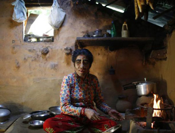 بالصور.. عائلة هندية تتخلص من متلازمة الذئبة بعلاج الليزر صورة رقم 10