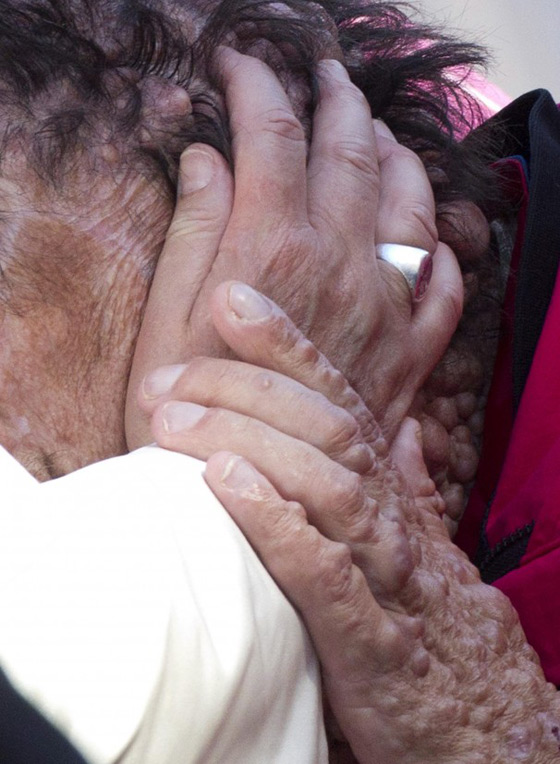 البابا فرنسيس يحتضن مصابا بمرض نادر ويأسر قلوب العالم صورة رقم 2