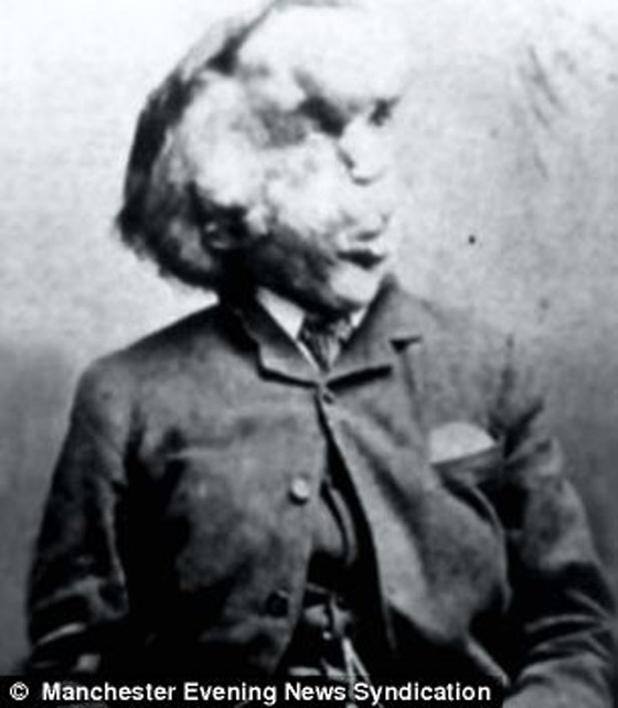 صور الرجل المشوه بالدمامل الذي قبله البابا فرنسيس وباركه صورة رقم 4