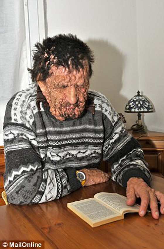 صور الرجل المشوه بالدمامل الذي قبله البابا فرنسيس وباركه صورة رقم 5