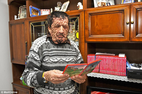 صور الرجل المشوه بالدمامل الذي قبله البابا فرنسيس وباركه صورة رقم 6