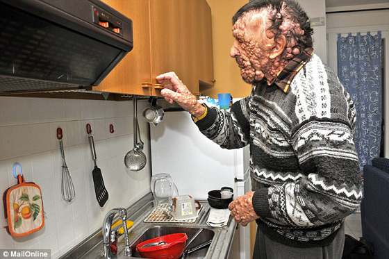 صور الرجل المشوه بالدمامل الذي قبله البابا فرنسيس وباركه صورة رقم 7