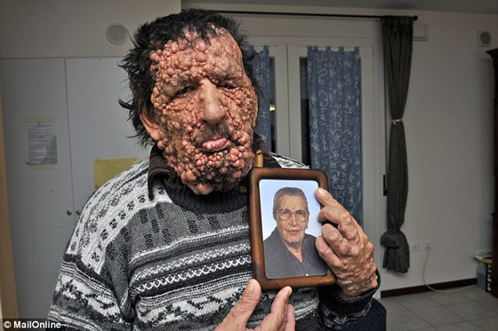 صور الرجل المشوه بالدمامل الذي قبله البابا فرنسيس وباركه صورة رقم 8