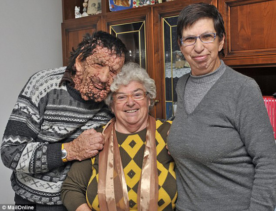 صور الرجل المشوه بالدمامل الذي قبله البابا فرنسيس وباركه صورة رقم 9