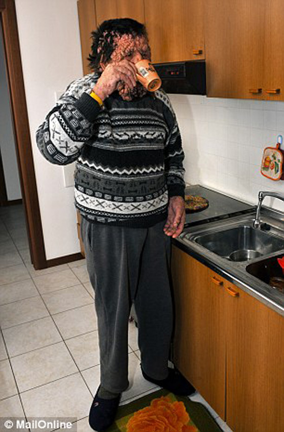 صور الرجل المشوه بالدمامل الذي قبله البابا فرنسيس وباركه صورة رقم 13