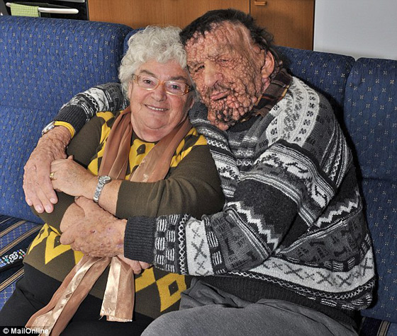 صور الرجل المشوه بالدمامل الذي قبله البابا فرنسيس وباركه صورة رقم 14