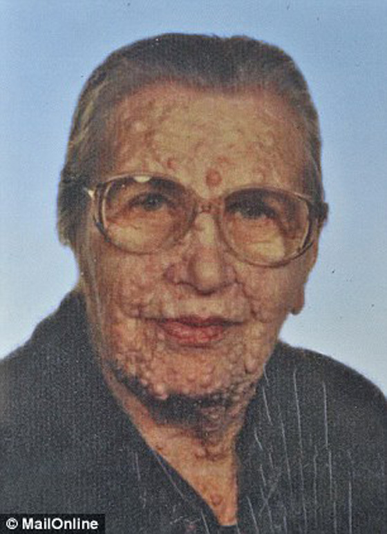 صور الرجل المشوه بالدمامل الذي قبله البابا فرنسيس وباركه صورة رقم 15