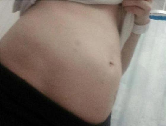 قصة البطن المنتفخ لمراهقة في ريعان الشباب صورة رقم 2