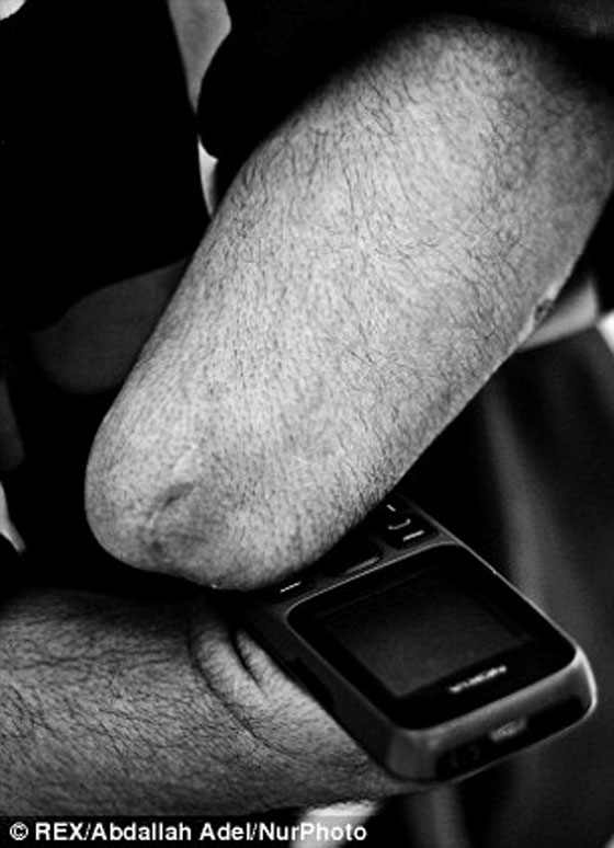  بالصور: علي عفيفي.. اول سارق في العالم يعاقب نفسه بقعه ليديه  صورة رقم 2