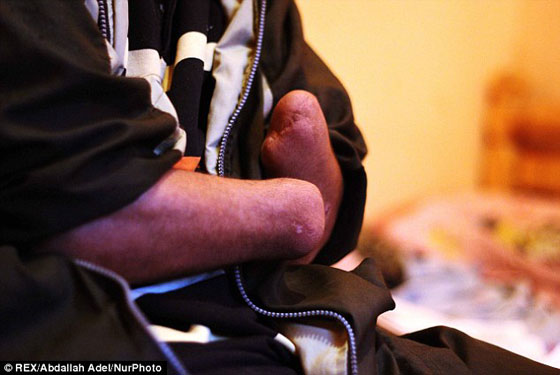  بالصور: علي عفيفي.. اول سارق في العالم يعاقب نفسه بقعه ليديه  صورة رقم 7