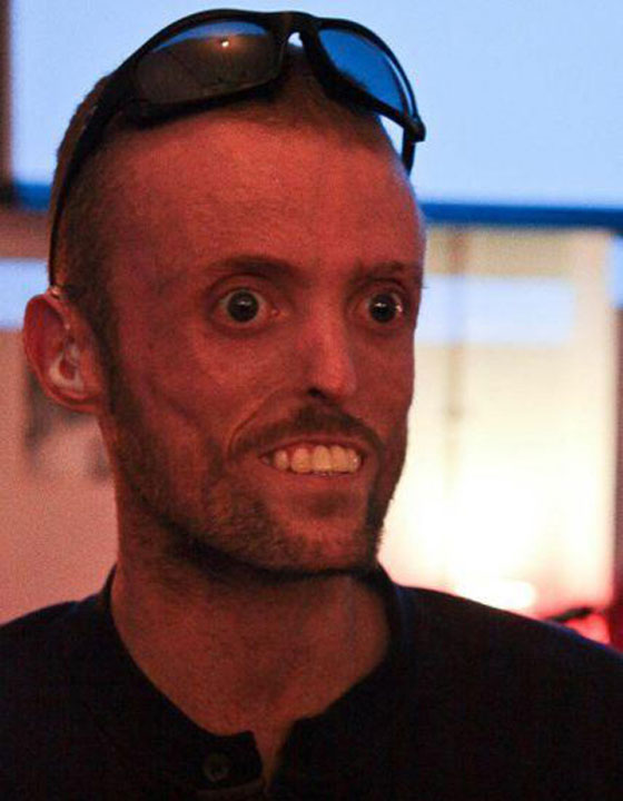 شاهدوا البريطاني الذي يرفض جسده الاحتفاظ بالدهون صورة رقم 1