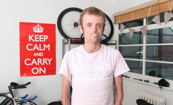 شاهدوا البريطاني الذي يرفض جسده الاحتفاظ بالدهون صورة رقم 10