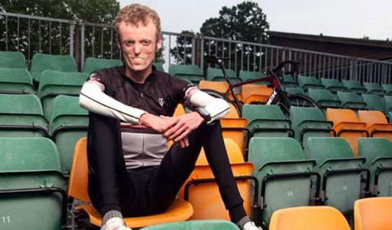 شاهدوا البريطاني الذي يرفض جسده الاحتفاظ بالدهون صورة رقم 9