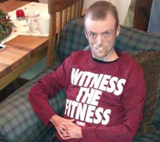 شاهدوا البريطاني الذي يرفض جسده الاحتفاظ بالدهون صورة رقم 4