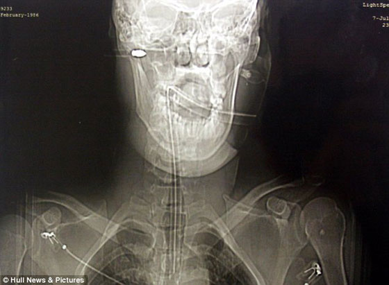 بأعجوبة نجا من سهم قاتل اخترق راسه صورة رقم 2