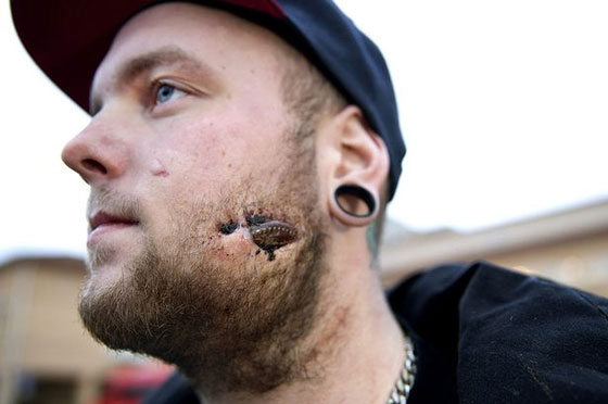 بعد شجار.. زجاجة علقت في خد شاب سويدي لمدة 17 يوماً  صورة رقم 1