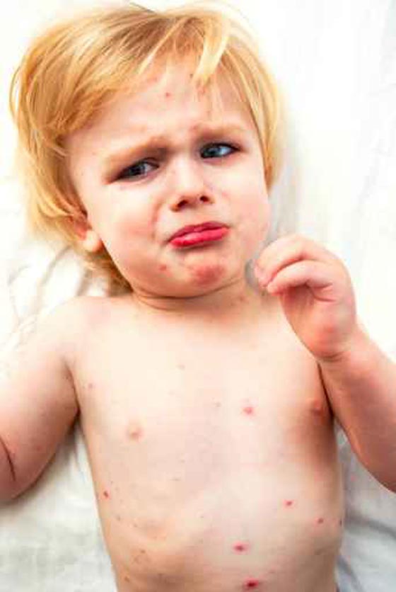 نيوزيلندا تبحث عن رضيع مصاب بالحصبة خوفا من انتقال العدوى صورة رقم 1