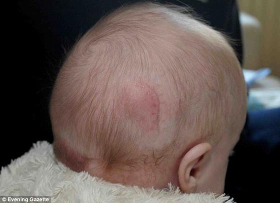 صور: طفلة ولدت وجزء من دماغها خارج جمجمتها وتحدّت الاطباء صورة رقم 3