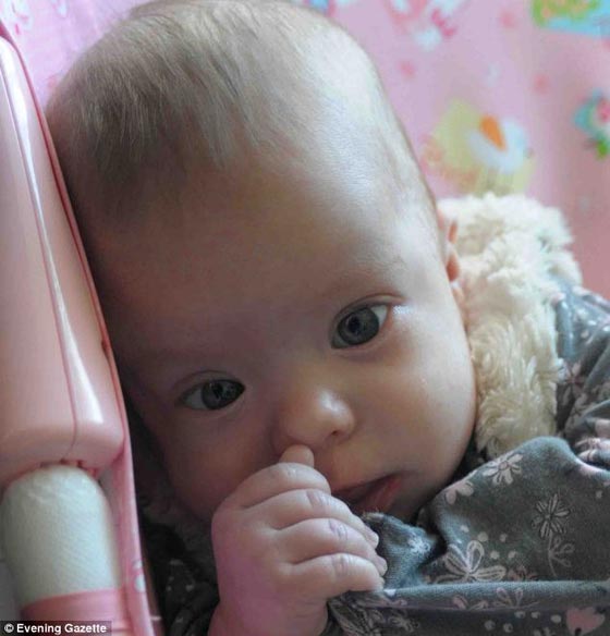 صور: طفلة ولدت وجزء من دماغها خارج جمجمتها وتحدّت الاطباء صورة رقم 2