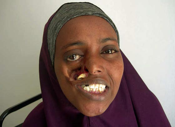 بالصور.. غدا ستعود البسمة لوجه ايان الذي شوهته شظايا الحرب  صورة رقم 2