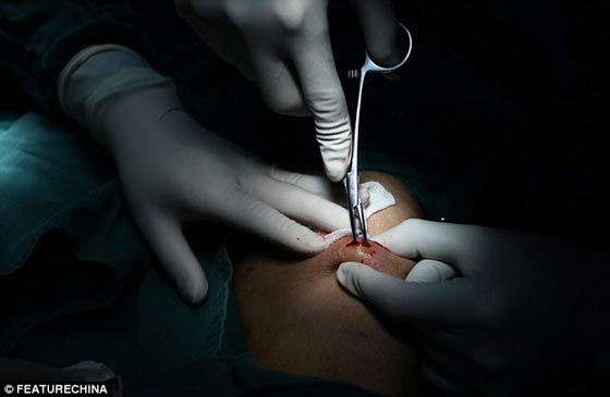 بالصور.. استخراج 42 لؤلؤة زرعت في جسد صيني لوقف الآلام! صورة رقم 1