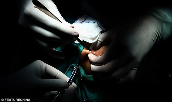 بالصور.. استخراج 42 لؤلؤة زرعت في جسد صيني لوقف الآلام! صورة رقم 2