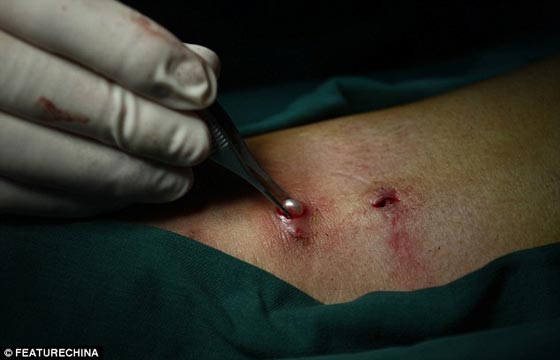 بالصور.. استخراج 42 لؤلؤة زرعت في جسد صيني لوقف الآلام! صورة رقم 3