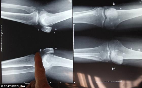 بالصور.. استخراج 42 لؤلؤة زرعت في جسد صيني لوقف الآلام! صورة رقم 4