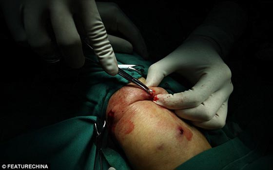 بالصور.. استخراج 42 لؤلؤة زرعت في جسد صيني لوقف الآلام! صورة رقم 5