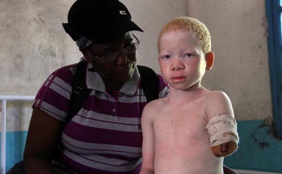 رفقا بالمهق.. فئة مستباحة للقتل والتعذيب بسبب السحر الأسود صورة رقم 3