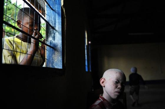 رفقا بالمهق.. فئة مستباحة للقتل والتعذيب بسبب السحر الأسود صورة رقم 2