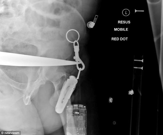 بالصور.. اخترقت جسمه شفرة حراثة زراعية.. ونجا باعجوبة!! صورة رقم 1