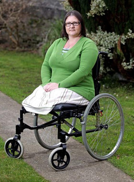 السجائر تسببت في بتر ساقيها.. فسارعت للتحذير منها بصورتها صورة رقم 2