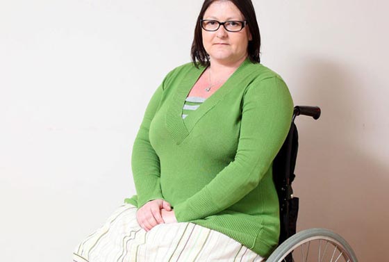 السجائر تسببت في بتر ساقيها.. فسارعت للتحذير منها بصورتها صورة رقم 3